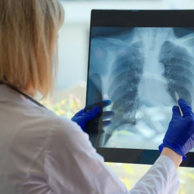 A person in a white coat looks at an xray of a rib cage and lungs.